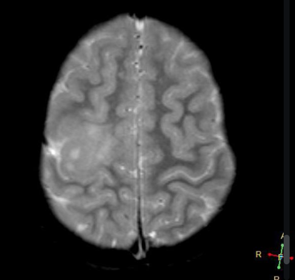 FCD
focal cortical dysplasia
限局性皮質異形成