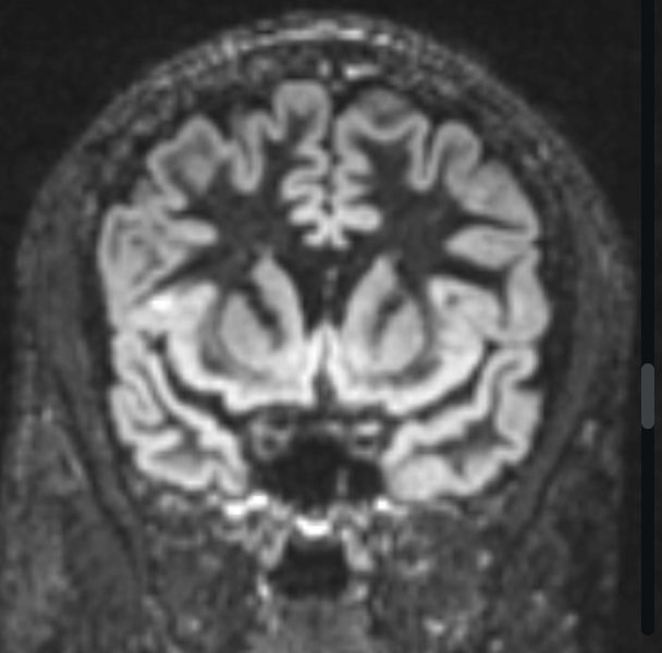 FCD
focal cortical dysplasia
限局性皮質異形成