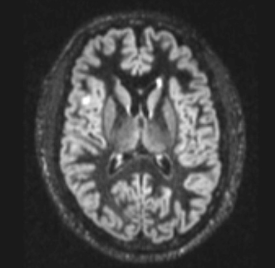 FCD
focal cortical dysplasia
限局性皮質異形成