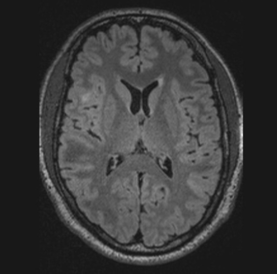 FCD
focal cortical dysplasia
限局性皮質異形成