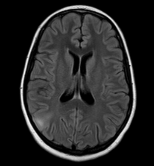 FCD
focal cortical dysplasia
限局性皮質異形成