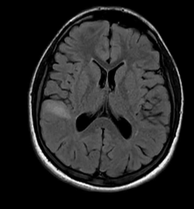 FCD
focal cortical dysplasia
限局性皮質異形成