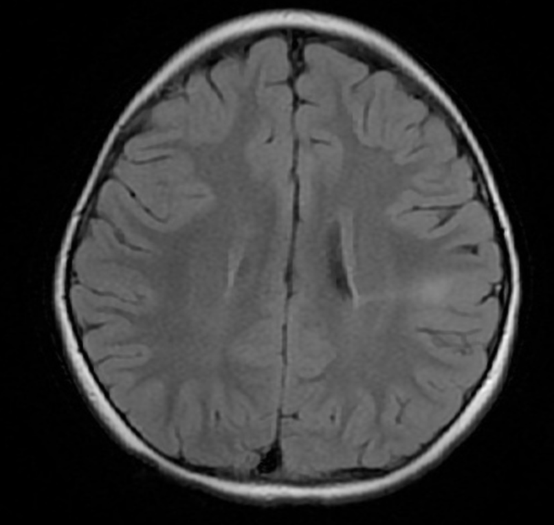 FCD
focal cortical dysplasia
限局性皮質異形成