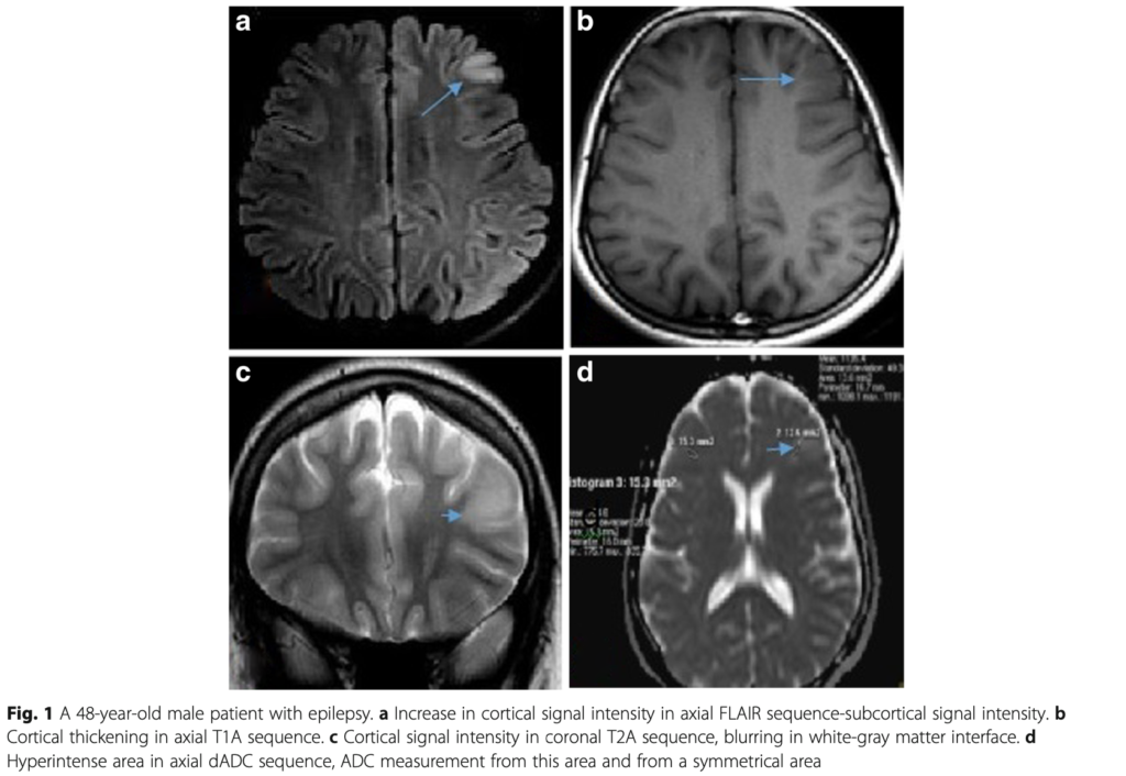 FCD
focal cortical dysplasia
限局性皮質異形成