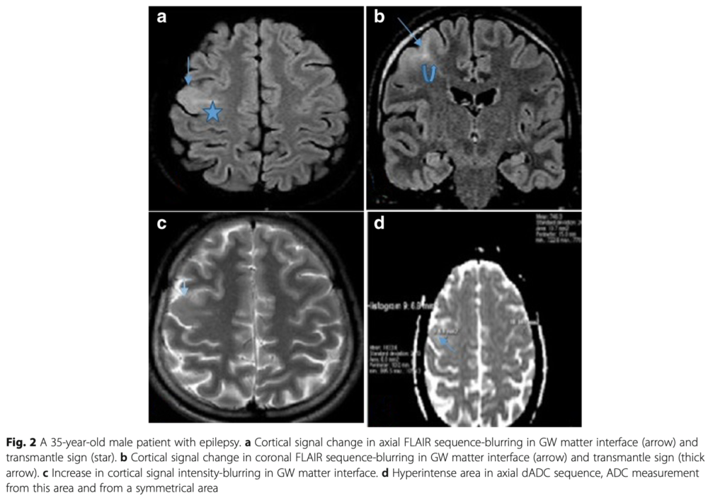 FCD
focal cortical dysplasia
限局性皮質異形成