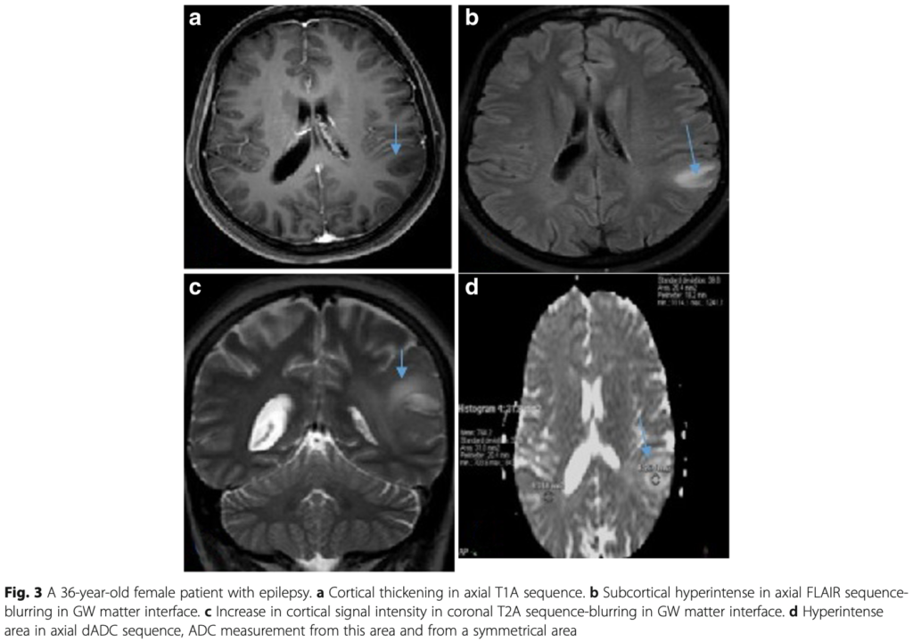 FCD
focal cortical dysplasia
限局性皮質異形成