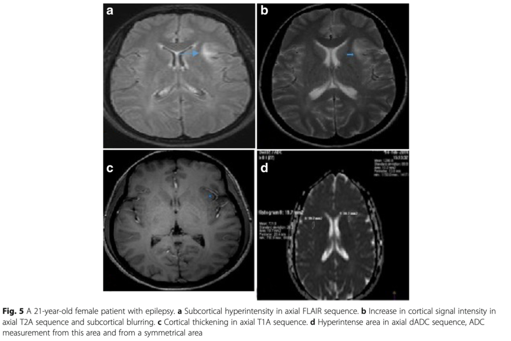 FCD
focal cortical dysplasia
限局性皮質異形成
case16