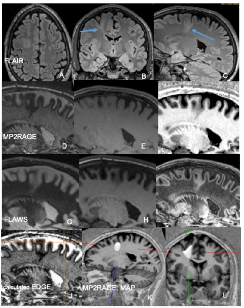 FCD
focal cortical dysplasia
限局性皮質異形成
case17