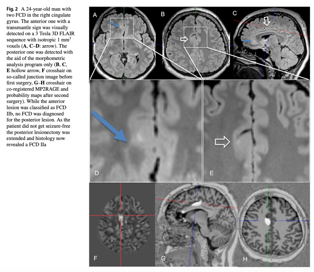 FCD
focal cortical dysplasia
限局性皮質異形成
case18