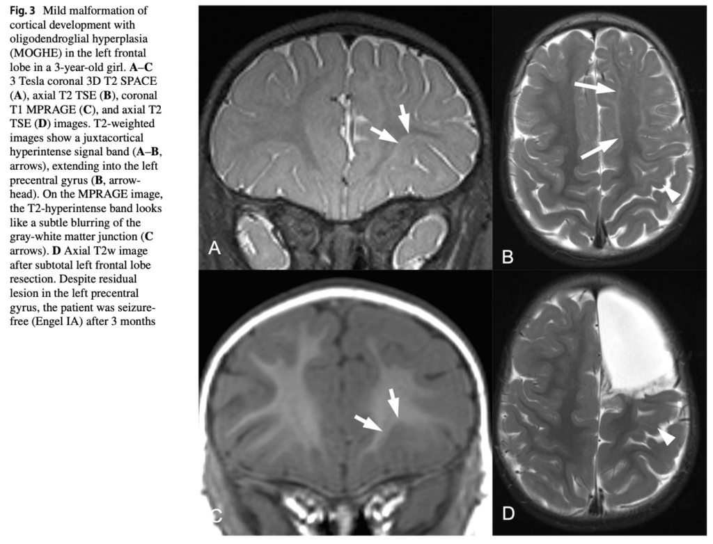 FCD
focal cortical dysplasia
限局性皮質異形成
case19