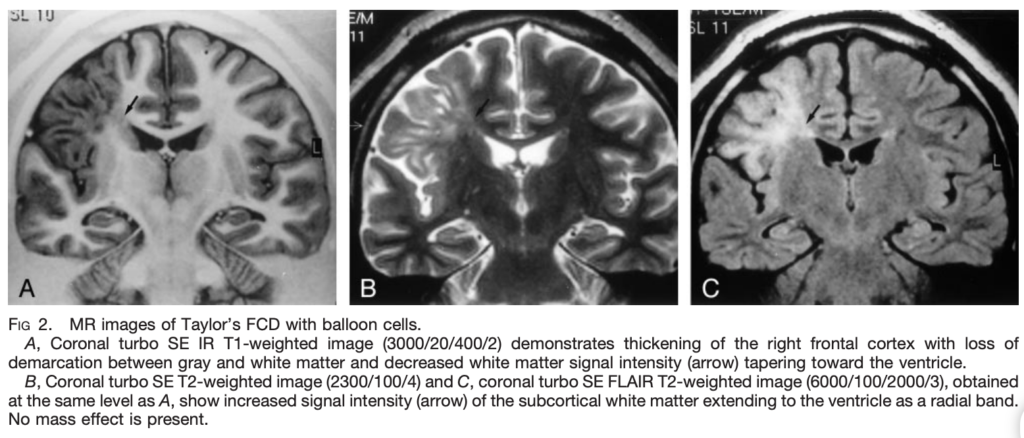FCD
focal cortical dysplasia
限局性皮質異形成
case20