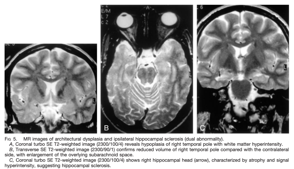 FCD
focal cortical dysplasia
限局性皮質異形成
case21