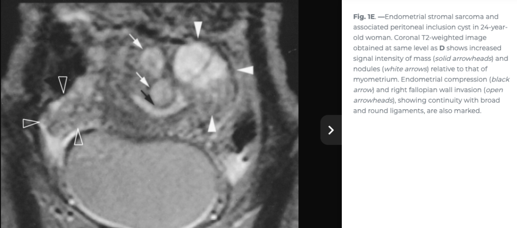 ESS
子宮内膜間質肉腫
endometrial stromal sarcoma
case9