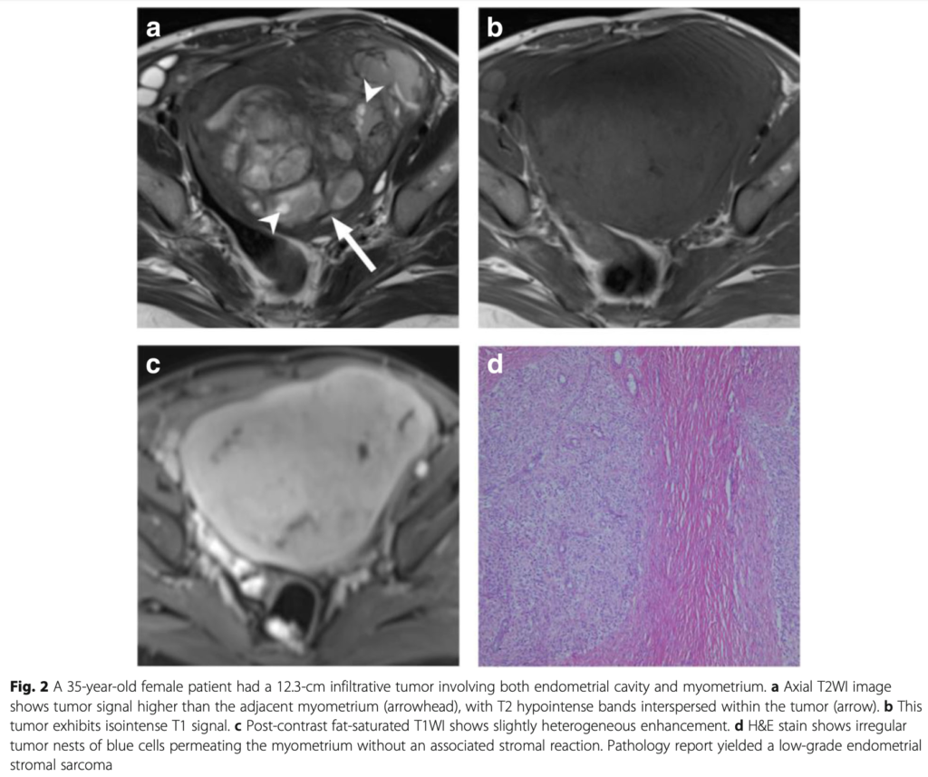 ESS
子宮内膜間質肉腫
endometrial stromal sarcoma
case7