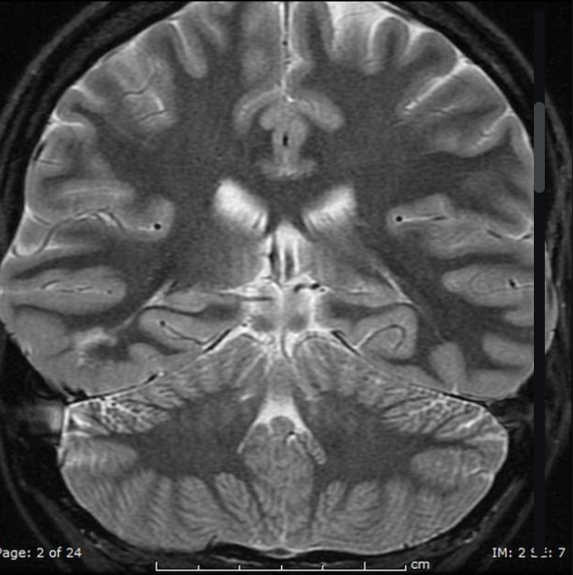 FCD
focal cortical dysplasia
限局性皮質異形成