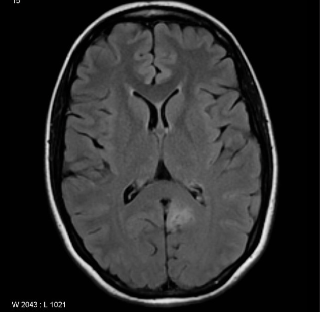FCD
focal cortical dysplasia
限局性皮質異形成
case7