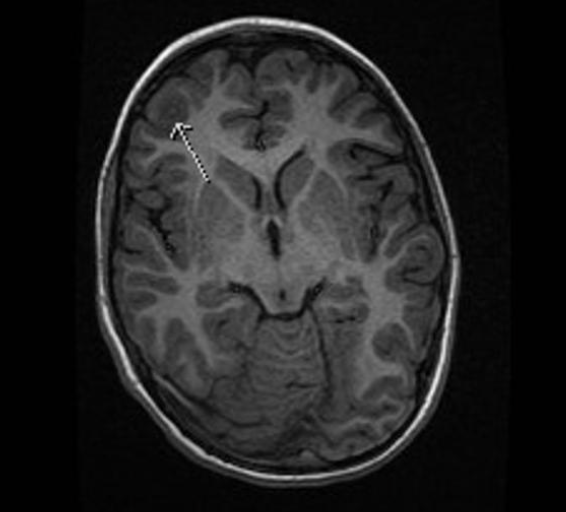 FCD
focal cortical dysplasia
限局性皮質異形成