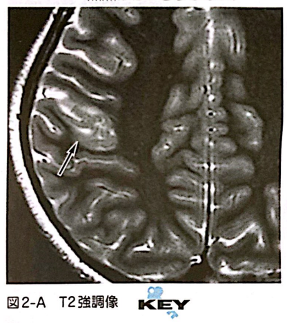 FCD
focal cortical dysplasia
限局性皮質異形成