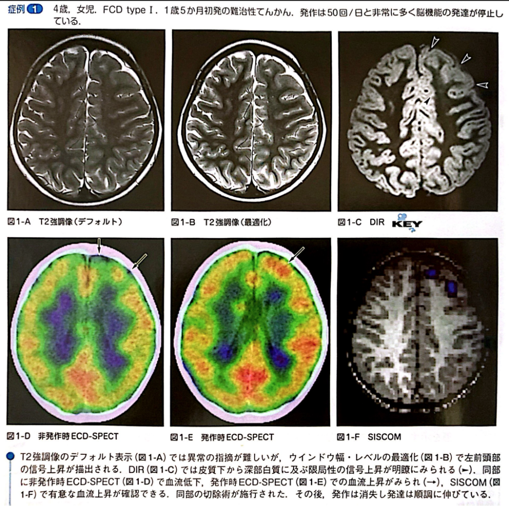 限局性皮質異形成
