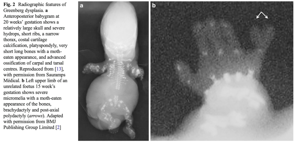 点状軟骨異形成症(chondrodysplasia punctata)
case1,2