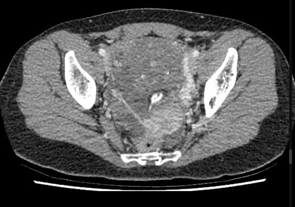 immature ovarian teratoma
case4