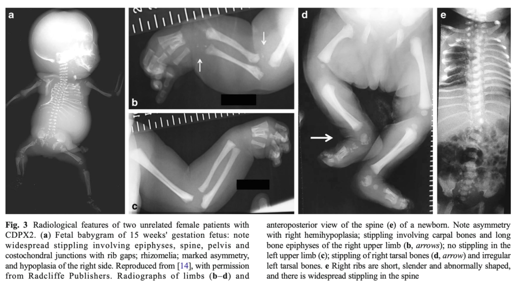 点状軟骨異形成症(chondrodysplasia punctata)
case3