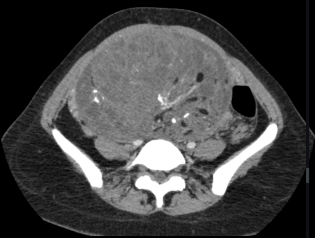 immature ovarian teratoma
case3